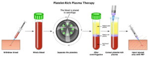 Platelet-rich plasma therapy in bali