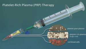 bali Platelet-rich plasma therapy