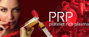 platelet rich plasma treatment